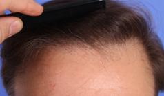 Before Hair Transplant&nbsp;Revision